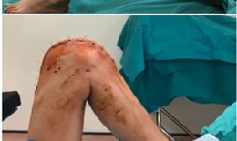 Tưởng bình thường khi đau âm ỉ kéo dài vùng gối trái: Nữ sinh 16 bị ung thư xương mà không biết