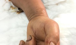 "Hồi sinh" cánh tay đứt rời vì tai nạn lao động cho người đàn ông ở Hà Nam
