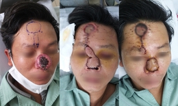 Từ cục mụn nhỏ trên mũi, người đàn ông đi khám bàng hoàng hóa ung thư