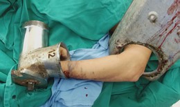 Do sơ sẩy người phụ nữ đến viện cấp cứu khi tay trong máy xay giò chả