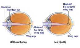 Thực trạng cận thị học đường v&#224; cong vẹo cột sốt ng&#224;y c&#224;ng tăng