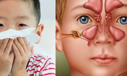 Có thể điều trị viêm xoang bằng cây lá?