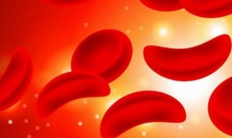Bệnh hồng cầu hình liềm và nguy cơ mắc COVID-19 trầm trọng