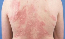 Nổi mề đay- Do đâu?