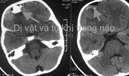 Bé trai bị đạn súng tự chế bắn xuyên sọ