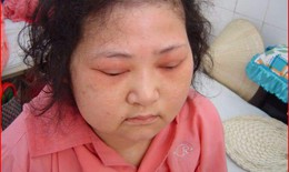 Hội chứng Cushing – bệnh lý thường gặp