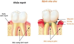 Bệnh nướu răng làm tăng nguy cơ sa sút trí tuệ