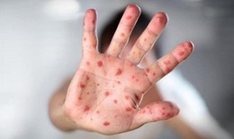 Rửa tay đúng cách - một trong những biện pháp đơn giản phòng ngừa sởi