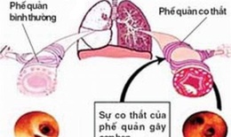 Ph&#234; duyệt thuốc gốc albuterol h&#237;t đầu ti&#234;n trị v&#224; ngăn ngừa co thắt phế quản