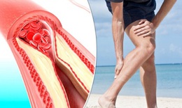 Căng thẳng trong công việc tăng nguy cơ mắc bệnh động mạch ngoại biên