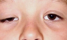 FDA phê chuẩn upneeq để điều trị sụp mí mắt ở người trưởng thành