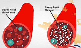 Kích hoạt đường huyết cao làm tăng nguy cơ tử vong ở bệnh nhân COVID-19