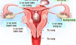Phẫu thuật và thuyên tắc trị u xơ tử cung giúp cải thiện chất lượng cuộc sống cho phụ nữ