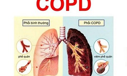 Thuốc h&#237;t  gi&#250;p điều trị duy tr&#236; COPD