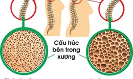 Thiếu hụt canxi và bổ sung thế nào cho đúng?