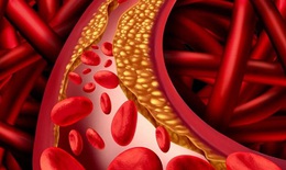 Tăng cholesterol cảnh báo mắc bệnh tuyến giáp