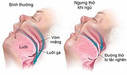 Phẫu thuật - Phương ph&#225;p khả thi để điều trị chứng ngưng thở khi ngủ