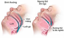 Điều trị ngưng thở khi ngủ ở người tiền tiểu đường, giảm nguy cơ mắc bệnh tim