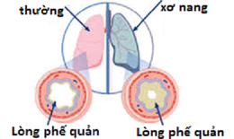 Thuốc cải thiện chức năng phổi ở bệnh nhân bị xơ nang
