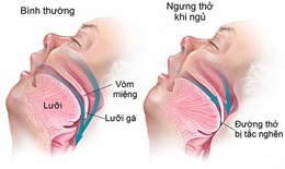 Rối loạn giấc ngủ làm tăng nguy cơ mắc Alzheimer