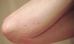 Viêm da dị ứng có liên quan đến các bệnh tự miễn dịch