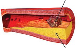 Bất lợi liên quan đến tim, ung thư của thuốc trị viêm khớp