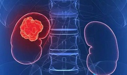 Thuốc mới trị ung thư thận tái phát: Phòng ngừa bất lợi của thuốc