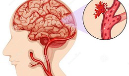 Bệnh nhân COVID -19 đối mặt với nguy cơ đột quỵ cao hơn