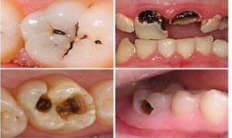 Sâu răng có thể làm tăng nguy cơ đột quỵ não
