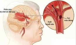 Chấn thương sọ não có thể làm tăng nguy cơ đột quỵ
