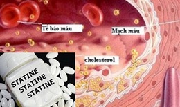 Đau khắp cơ thể, một bất lợi không nên bỏ qua khi dùng statin trị mỡ máu