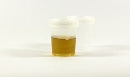 Màu sắc của nước tiểu có thể báo hiệu tổn thương gan do thuốc trị mỡ máu