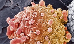 Ung thư da: Thuốc miễn dịch trị liệu có thể tiêu diệt 20% số khối u