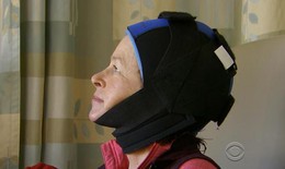 Mũ lạnh giúp phụ nữ tránh rụng tóc khi hóa trị ung thư vú