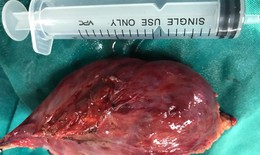 Phẫu thuật thành công nội soi lồng ngực lấy khối u trung thất khổng lồ