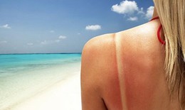 Tổn thương da do nắng và cách hồi phục hiệu quả