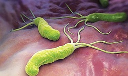 Nhiễm vi khuẩn Helicobacter Pylori (HP) có trở thành ung thư?