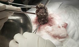 Búi tóc gần 1 kg gây tắc ruột bé gái 6 tuổi có sở thích... ăn tóc