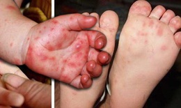 Bé gái 2 tuổi tử vong do mắc tay chân miệng độ IV