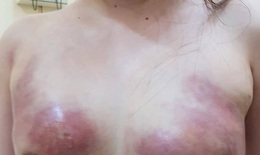 Kinh hoàng: bơm mỡ nhân tạo cô gái phải cắt bỏ ngực hoại tử, lấy ra 400 ml dịch mủ