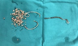 Hy hữu: Ống th&#244;ng “stent jj” ở niệu quản suốt  5 năm g&#226;y đ&#225;i rắt, đ&#225;i buốt…trong thời gian d&#224;i