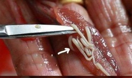 Điểm một số ca bệnh ký sinh trùng ở người cần lưu ý