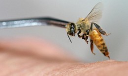 Hiếm gặp, bệnh nhân bị biến chứng nhồi máu cơ tim cấp do bị ong đốt
