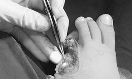 Lần đầu tiên nối  thành công ngón út bàn chân cho bé nhỏ tuổi bằng kỹ thuật siêu vi phẫu