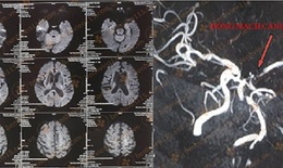 Cứu thành công trường hợp đột quỵ nhồi máu não nặng liệt nửa người phải