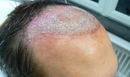 Kinh hoàng: Cấy tóc trị hói ở cơ sở tư nhân khiến đầu chi chít ổ áp xe