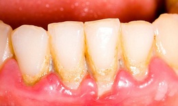 Cảnh báo:  Viêm nha chu có thể gây rụng răng
