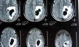 Ăn tiết canh, người đàn ông bị sán làm tổ trong não