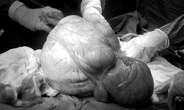 5 giờ phẫu thuật thành công khối u xơ tử cung khủng nặng 6,3 kg