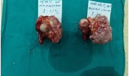 Bác sĩ cảnh báo u xương lành có thể chuyển thành ác tính nếu chủ quan